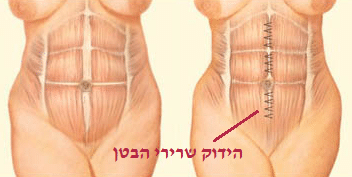 tummy tuck muscle tightening