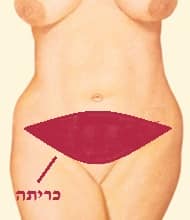 tummy-tuck fat removal