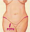 tummy tuck scar