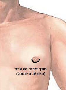 gynecomastia 1
